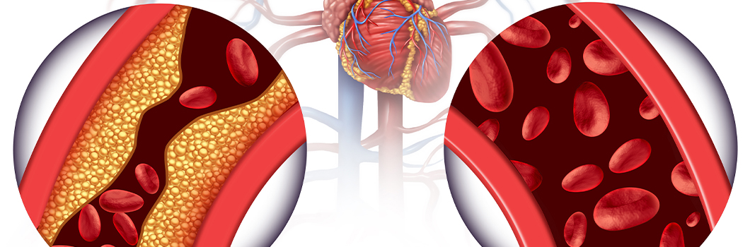 wysoki cholesterol ldl skutki