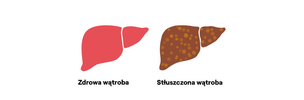 zdrowa i stłuszczona wątroba