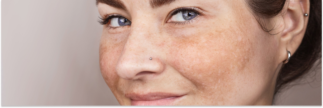 plamy pigmentacyjne na twarzy