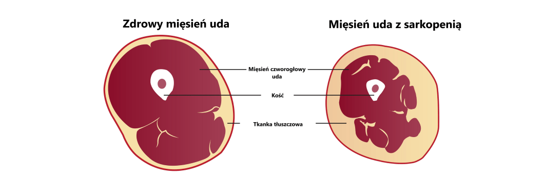 zanik mięśni nóg u osób starszych