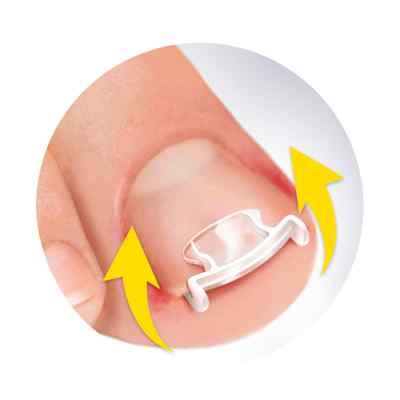 Scholl Eingewachsene Zehennägel Clips & Spray Scholl Eingewachsene Zehennägel Clips & Spray